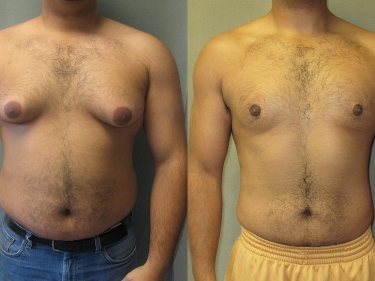 Male Breast Reduction Surgery Cost